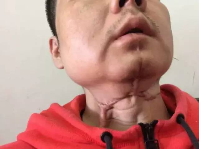 被咬掉舌头的主播，逆境中的重生