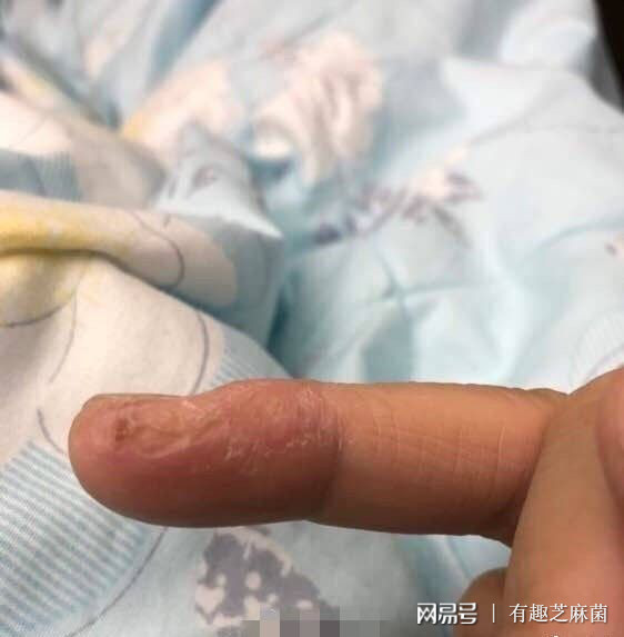 多位捏捏玩家遭遇喉咙痛与烂手指，游戏健康隐患引关注