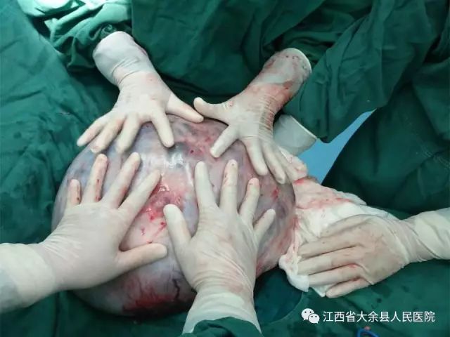 女子被切除子宫，深度解析与心理调适