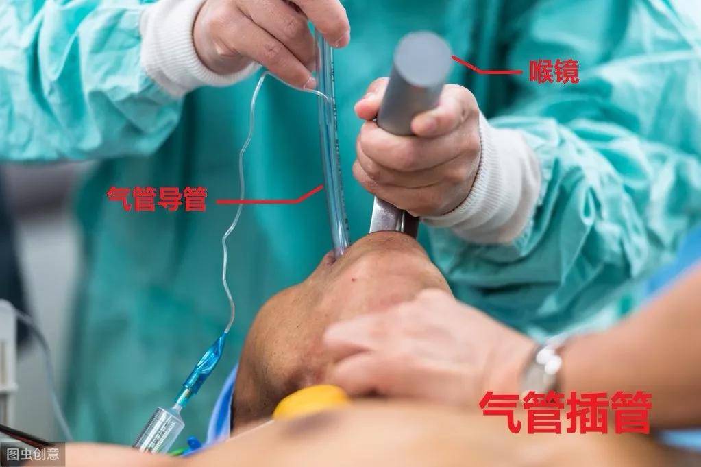 医院气管插错致患者死亡，家属发声背后的医疗伦理与社会责任探讨