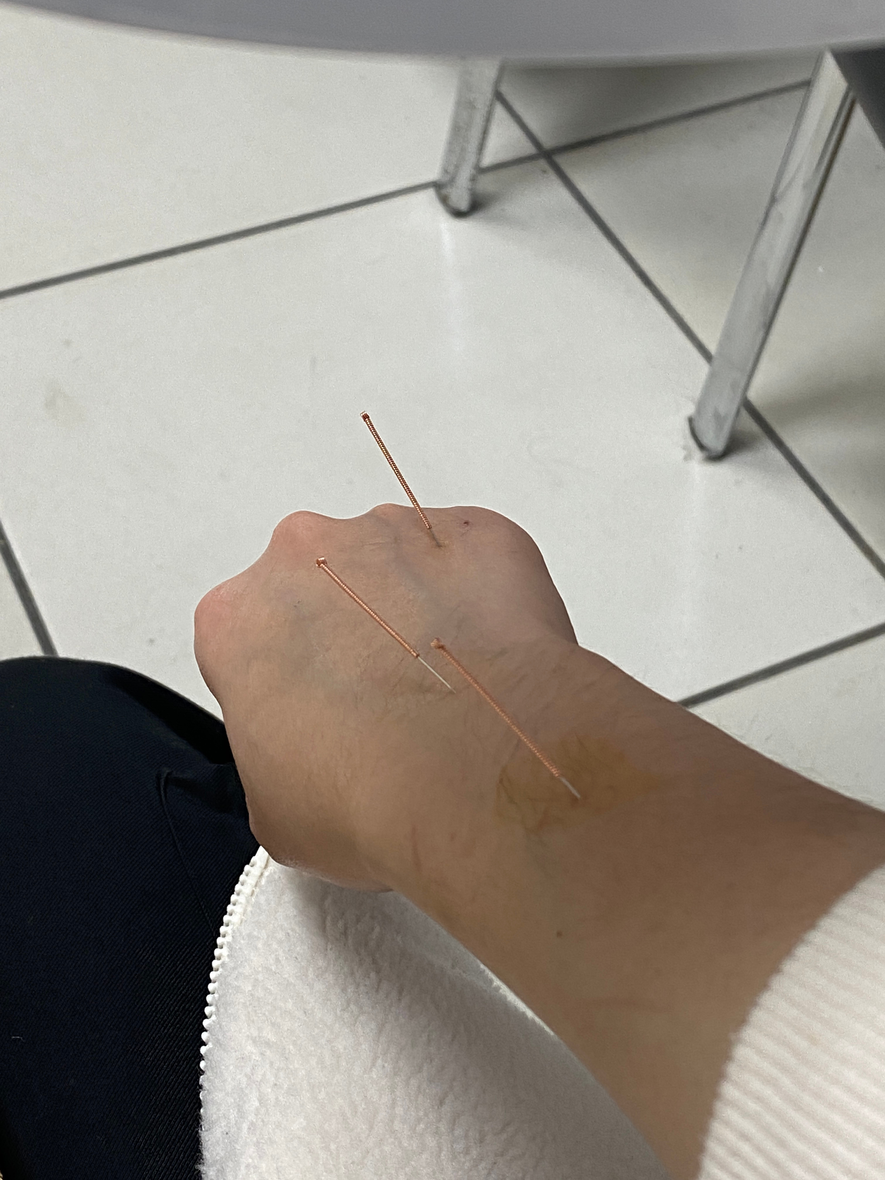 被注射器扎到会痛吗？揭秘注射过程中的真实感受